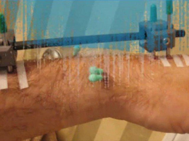 sprained wrist treatment – sprain wrist treatment