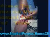 nail fungus removal - fungus under toenail