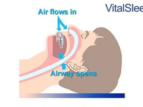 Anti-Snoring Mouthguard and Mouthpiece from VitalSleep