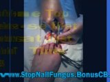 nail fungus home remedies - how to cure fungus nails
