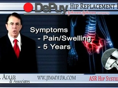 DePuy ASR Hip Replacement System Recall