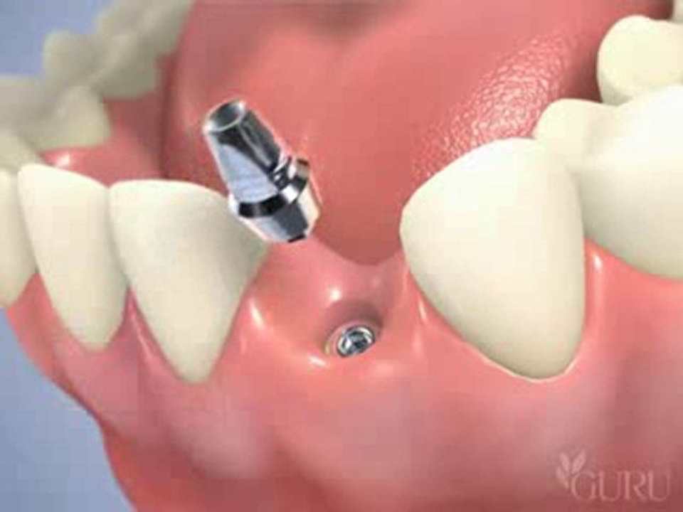 pose d'implant dentaire en 2 temps sur incisive
