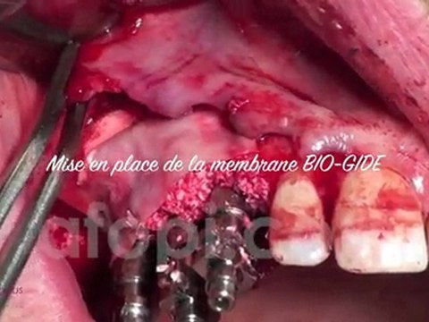 Gestion des alvéoles aux murs altérés - Dr. Jean-Louis Zadikian - Afopi Campus