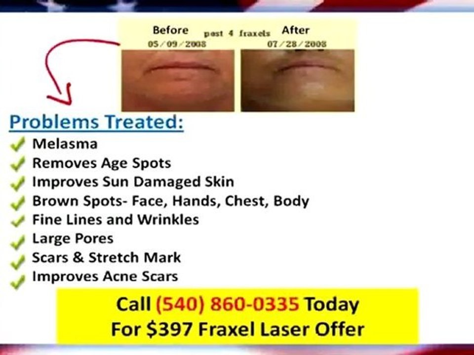 Laser For Skin Portsmouth VA|$397Fraxel Laser|Medi Spa