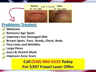 Laser Skin Rejuvenation Staunton Va|$397 Cosmetic Laser