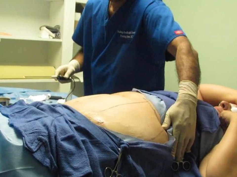 Laser Liposuction-Orange County-Los Angeles County-San bernardino County-Inland Impire-Whittier-pasadena-Anaheim-Irvine
