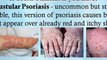 psoriasis treatment natural - new psoriasis treatment - severe psoriasis