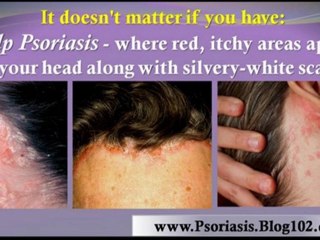 psoriasis natural treatment - treatment for psoriasis - psoriasis scalp
