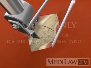 Bone Graft Harvesting Surgery anterior iliac crest orthopedic illustrations