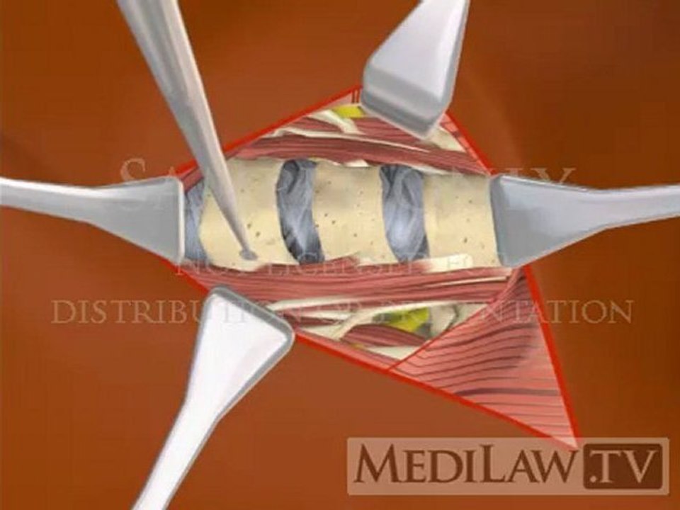 Cervical Spine Surgical Anterior Approach Vertical Incision surgery animations