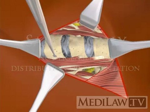 Cervical Spine Surgical Anterior Approach Vertical Incision surgery animations