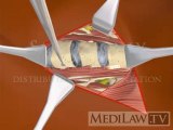 Cervical Spine Surgical Anterior Approach Vertical Incision surgery animations
