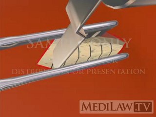 Bone Graft Harvesting Surgery posterior iliac crest surgical fusion presentations