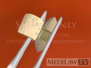 Bone Graft Harvesting Surgery posterior iliac crest surgical fusion movies