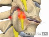 Cervical Spine Movement Intervertebral Degenerative Disc Disease Osteo-arthritis Spondylosis physiotherapy multimedia