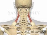 Cervical Spine Shoulder Elevation Muscles Levator Scapulae chiropractic presentations