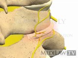 Cervical Spine Pathology Facet Zygoapophysial Joint Syndrome chiropractic multimedia