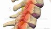 Cervical Spine Pathology Rheumatoid Arthritis Spondylitis Sub-axial Subluxation chiropractor movies