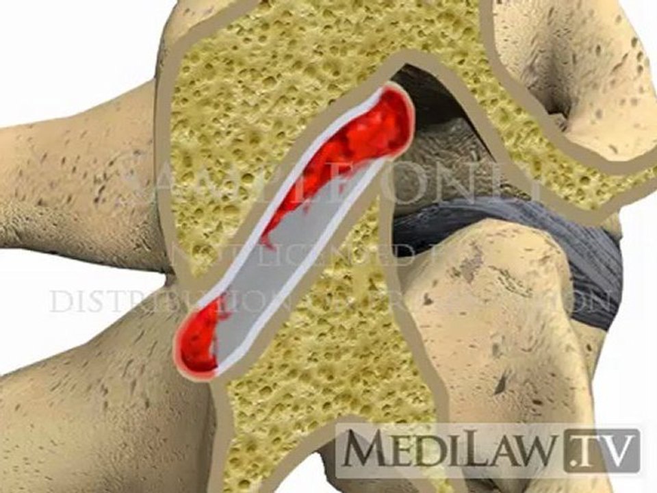 Cervical Spine Pathology Rheumatoid Arthritis Facet Joint Spondylitis courtroom 3D animations