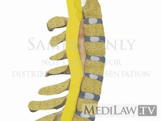 Cervical Pathology Ossified Posterior Longitudinal Ligament expert witness testimony multimedia