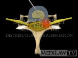 Cervical Spine Percutaneous Automated Inter-vertebral Discectomy pain management 3D illustrations