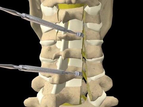Cervical Spine Surgery Decompression Laminoplasty with metal strut fixation orthopaedic surgery patient education