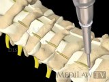 Cervical Spine Surgical Decompressive Laminoplasty with bone strut fixation surgical decompression videos