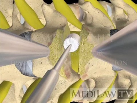 Cervical Spine Surgery Interbody Vertebral Fusion with cage fixation orthopaedic surgery movies