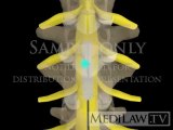 Lumbar Spine Spinal Cord Neuro-stimulation paddle electrode pain management multimedia