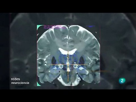 Estimulacion cerebral profunda: Enfermedad de Parkinson