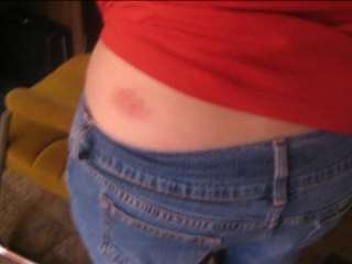 Ringworm Cure - Ringworm Removed - Ringworm Remedy