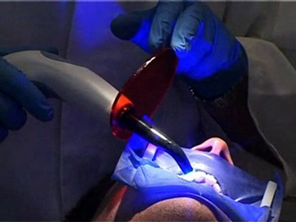 Smartlite de Dentply