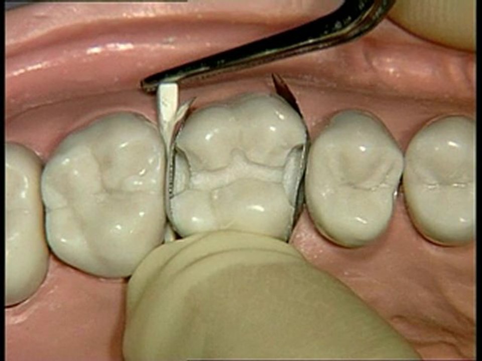 Démonstration de Palodent de Dentsply
