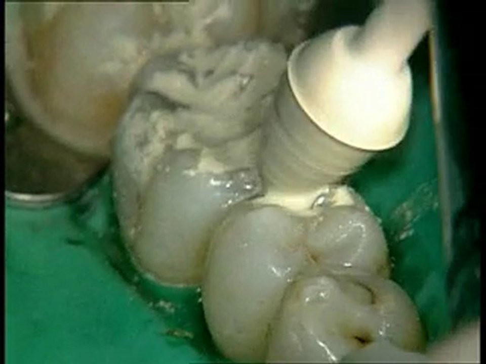 Démonstration des polissoirs Pogo de Dentsply