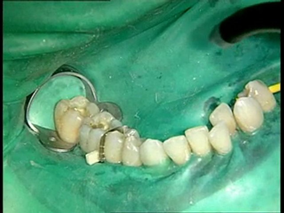 Adhésif Xeno de Dentsply