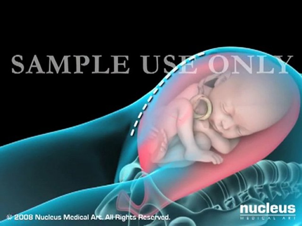 Cesarean Birth (C-section) Delivery _amp; Birth