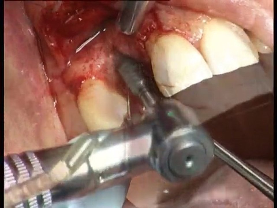 cas clinique implant Straumann en remplacement de 12