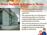 Dental implants at Tijuana in Mexico from best dentists