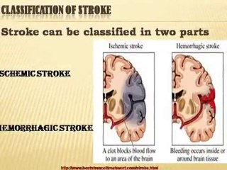 Stroke treatment at Tijuana in mexico at affordable Cost