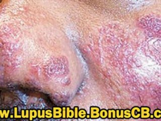 Скачать видео: the lupus bible - lupus treatment - lupus cure - lupus holis