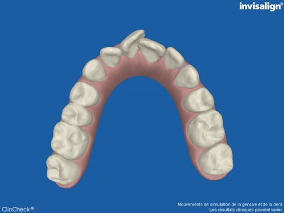film occlusal haut