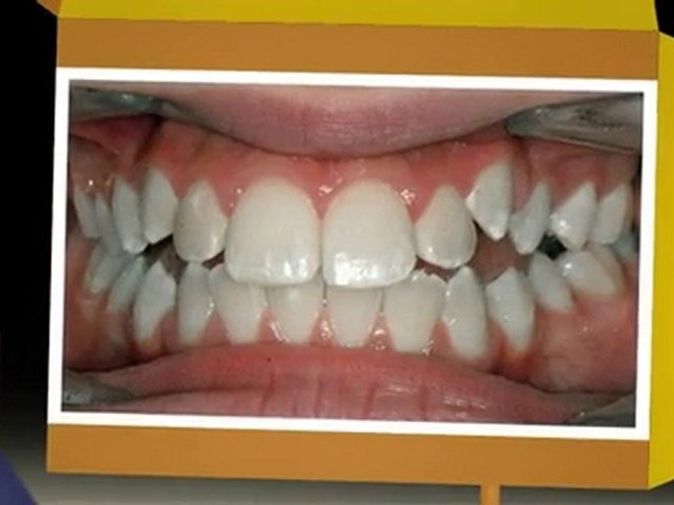 Orthodontist Braces Westminster