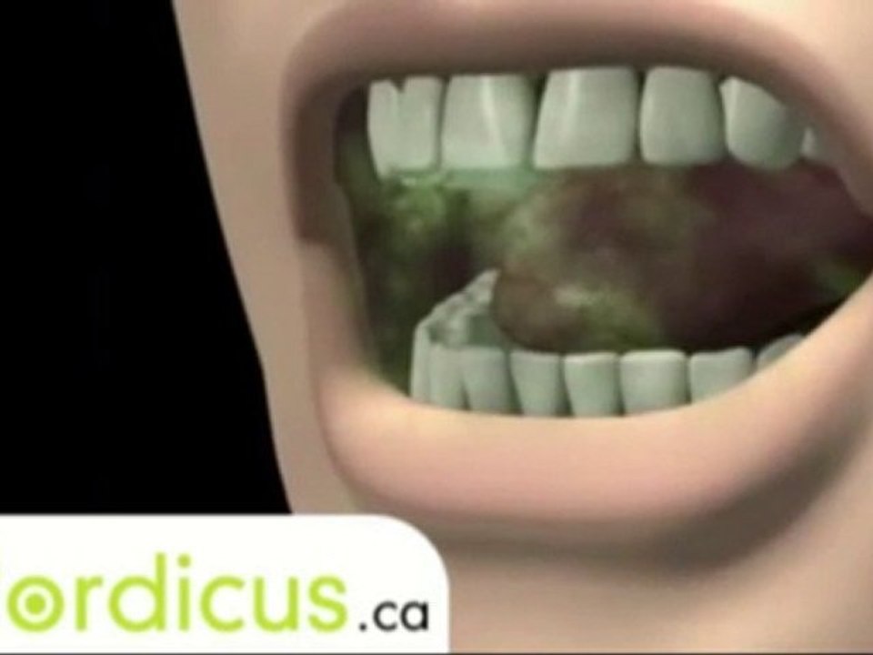 Consequence de malocclusion - Éducation dentaire