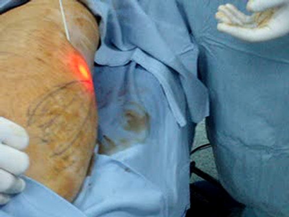 LIPOSUCTION BY LASERشفط الدهون