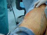 شفط الدهون-liposuction
