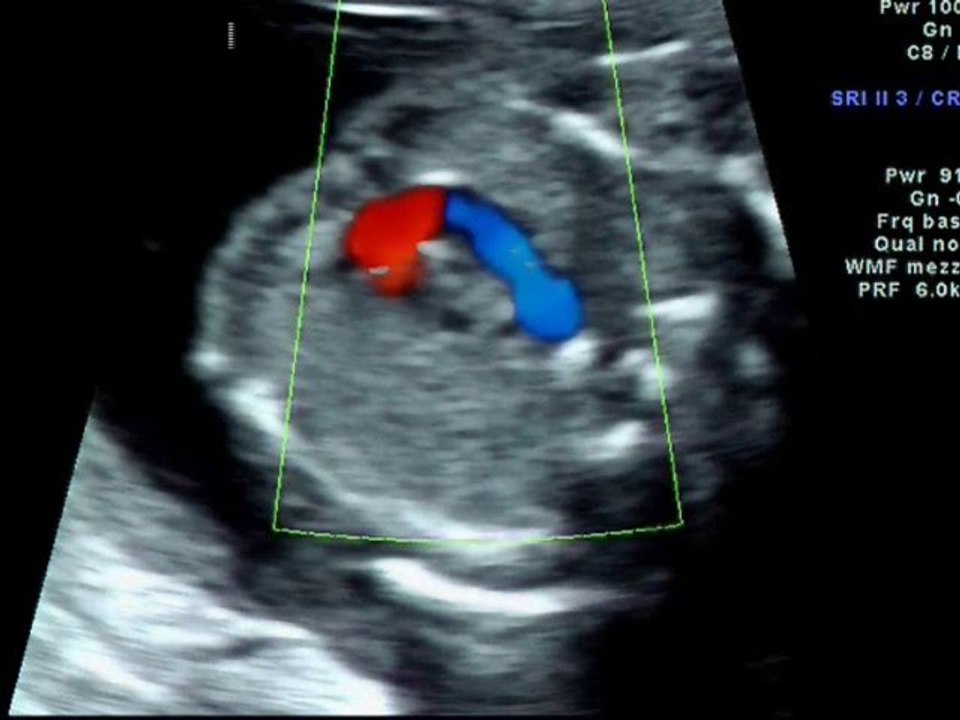 Sindrome cardiosplenica