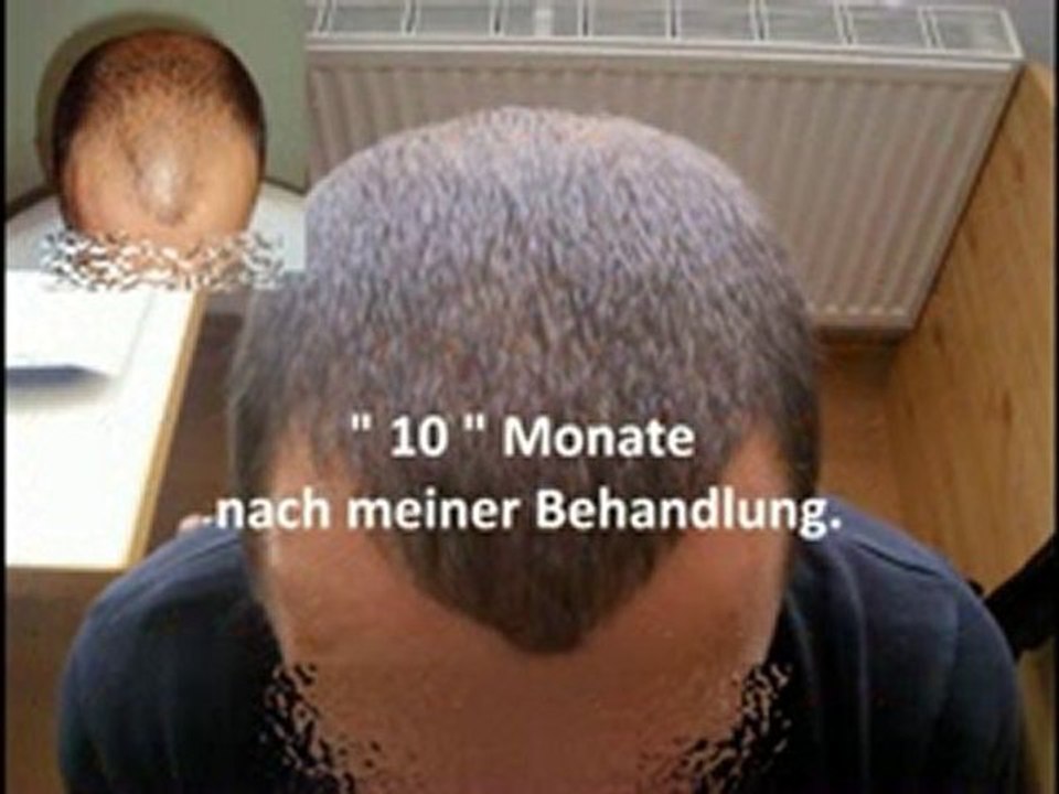 Haartransplantation über www.melplast.de in Istanbul.