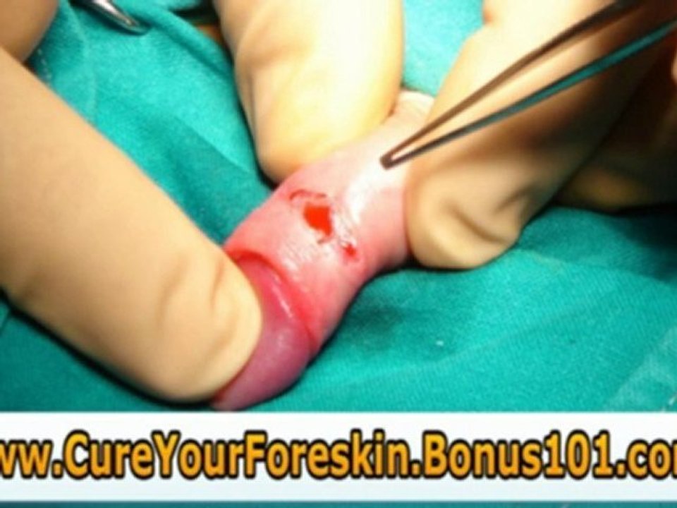 how to cure tight foreskin naturally - yeast infection fores