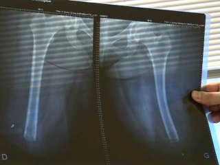 Calaisis TV: Une Palestinienne opèrèe au CHC