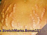 stretch marks product review - get rid of stretch marks fast